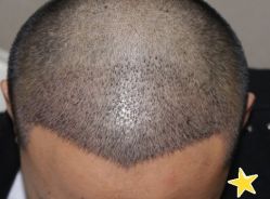 -大麦微针植发丨全国连锁