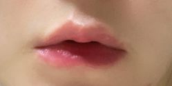 体验后-广州健丽·去眼袋医疗美容机构