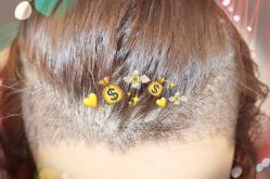 -大麦微针植发全国连锁