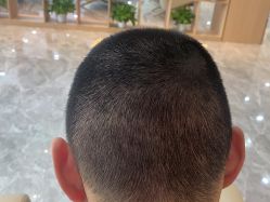-碧莲盛·不剃发植发