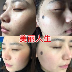 -美丽人生祛斑扁平疣汗管瘤中心