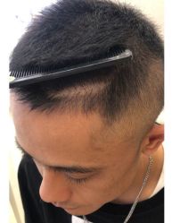 -大麦微针植发全国连锁