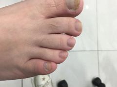 -世龙世家灰指甲·甲沟炎·跖疣护理·修脚(东江湾路店)