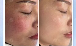 -美肤盾祛痘·问题肌头疗管理中心