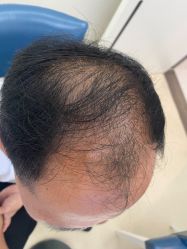 点击看大图 -大麦微针植发丨全国连锁