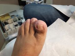 -世龙世家灰指甲鸡眼脚气甲沟炎跖疣护理(通州店)