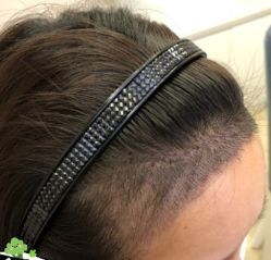 -大麦微针植发丨全国连锁