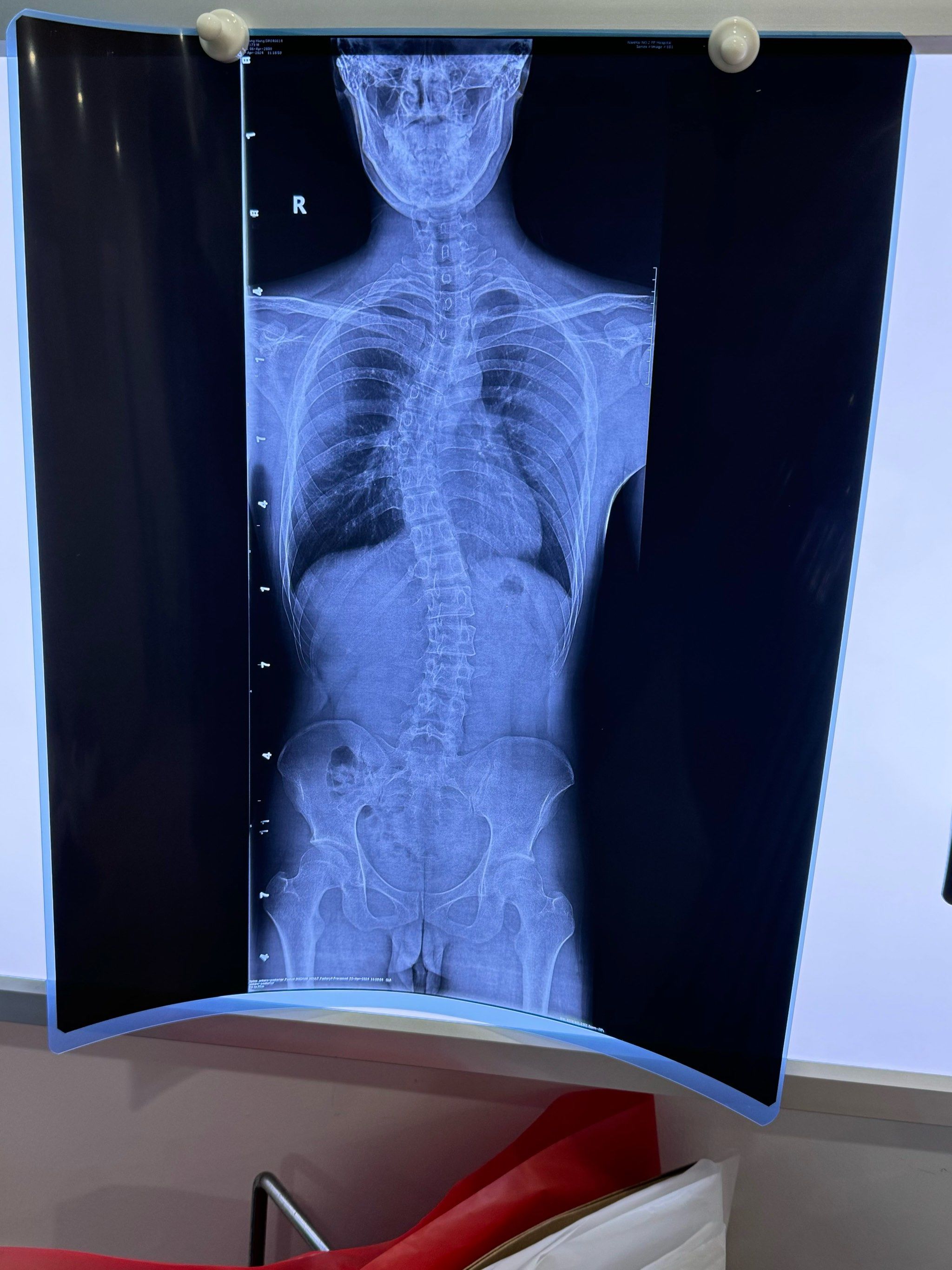 脊柱弯的太难受了