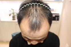 -大麦微针植发丨全国连锁