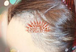 -大麦微针植发全国连锁