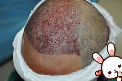 点击看大图 -大麦微针植发丨全国连锁