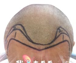 -大麦微针植发全国连锁