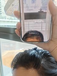 -碧莲盛·不剃发植发