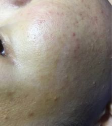 -蕾特恩祛痘•皮肤管理