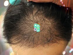 -大麦微针植发全国连锁