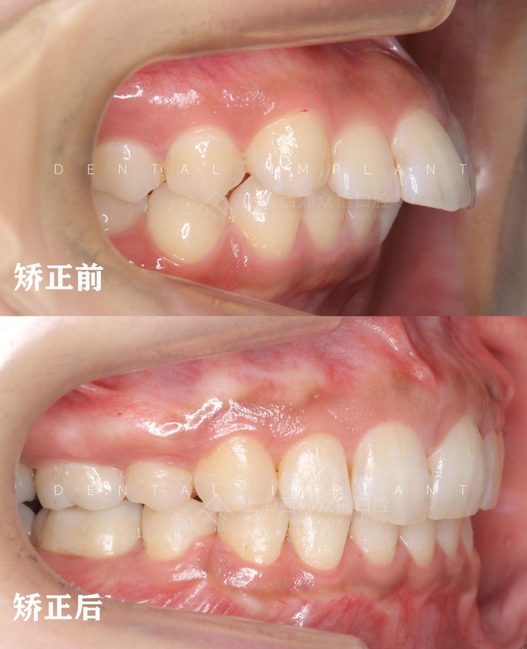 yyds 龅牙矫正 整牙如换脸