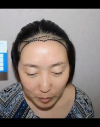 点击看大图 -大麦微针植发全国连锁