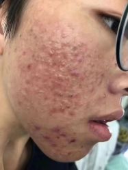 -苗方清颜专业祛痘连锁机构