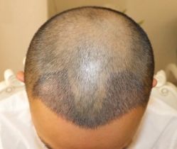 -大麦微针植发全国连锁