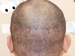 -大麦微针植发全国连锁