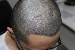 -大麦微针植发丨全国连锁