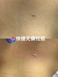 -清疣美疣·痣·斑净肤中心