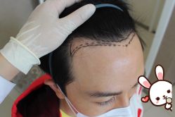 -大麦微针植发丨全国连锁