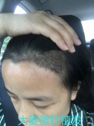 点击看大图 -大麦微针植发丨全国连锁
