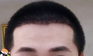 -大麦微针植发丨全国连锁