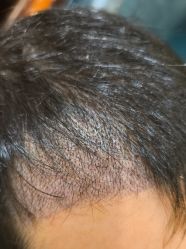 -碧莲盛·不剃发植发