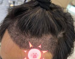 -大麦微针植发全国连锁