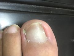 治疗前-Andrew指甲专科灰指甲·甲沟炎矫正·3D步态矫形鞋垫定制(上海法华镇路旗舰店)