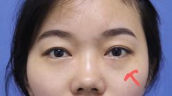 -天津健丽·去眼袋医疗美容机构