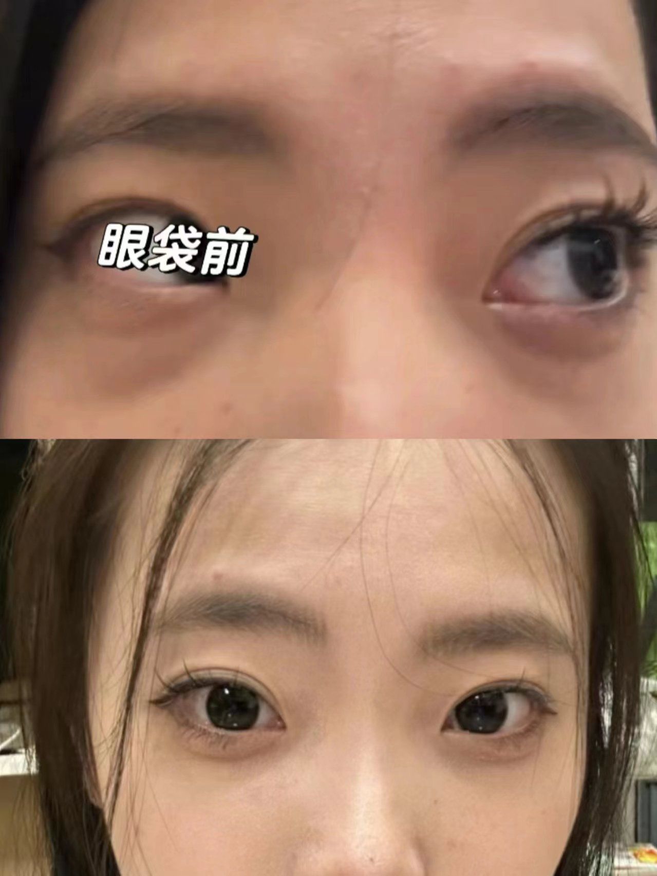 为什么眼袋很重 为什么眼袋很重