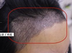 -大麦微针植发全国连锁