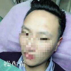 -西施无菌半永久纹绣眉眼影唇轻增发纹发际线