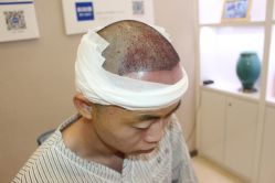 -大麦微针植发丨全国连锁