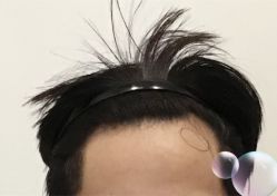 -大麦微针植发全国连锁