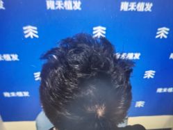 -雍禾植发全国连锁