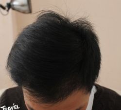 -大麦微针植发丨全国连锁