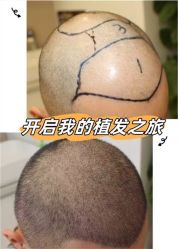 -大麦微针植发全国连锁