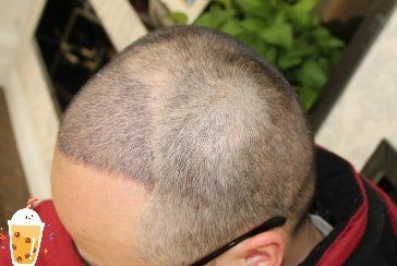 -大麦微针植发丨全国连锁