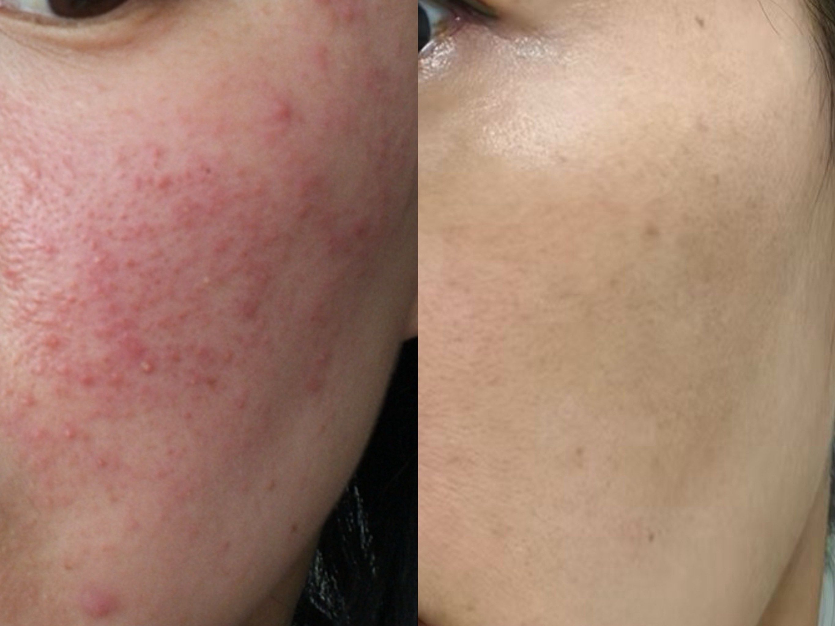 洗完脸鼻子为什么会红 洗完脸鼻子为什么会红