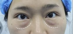 -天津健丽·去眼袋医疗美容机构