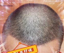 -大麦微针植发全国连锁