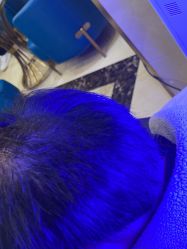 -碧莲盛·不剃发植发