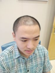 -大麦微针植发全国连锁