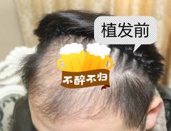 -大麦微针植发全国连锁