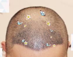 -大麦微针植发全国连锁