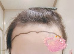 -大麦微针植发全国连锁